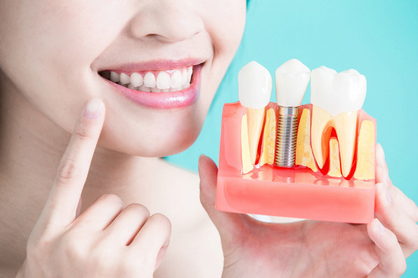 Сколько служат зубные импланты, как часто отторгаются и как продлить их эксплуатационный период?