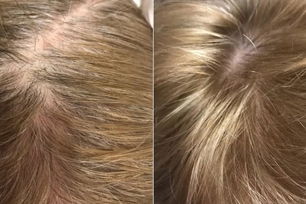 Регенерация волос Regenera: как все происходит и какой эффект от проце