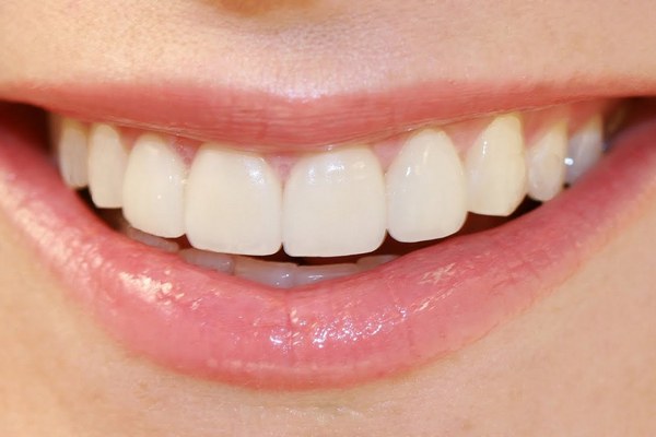 Кто рискует «встретиться» с гипоплазией зубной эмали и можно ли вылечить это заболевание