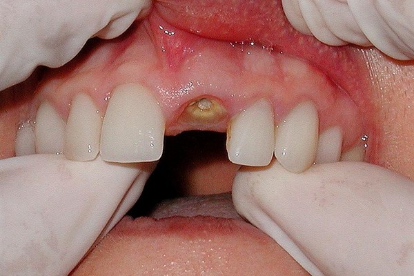 Альвеолит или воспаление лунки после удаления зуба: почему возникает о