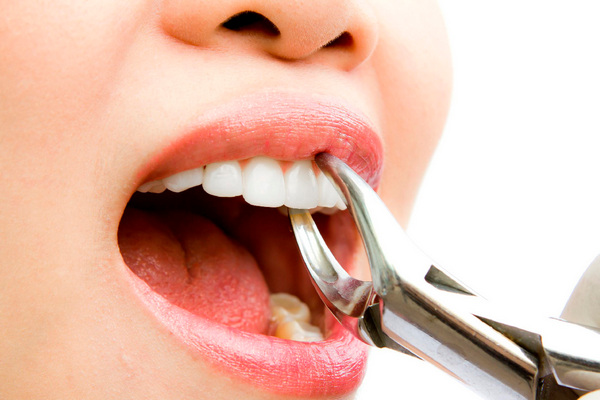 Альвеолит или воспаление лунки после удаления зуба: почему возникает осложнение и как его лечить