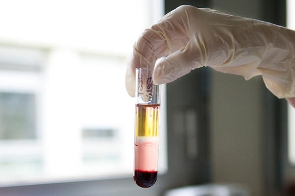 Ученые выяснили, что анализ крови способен показать вероятность развития психических отклонений