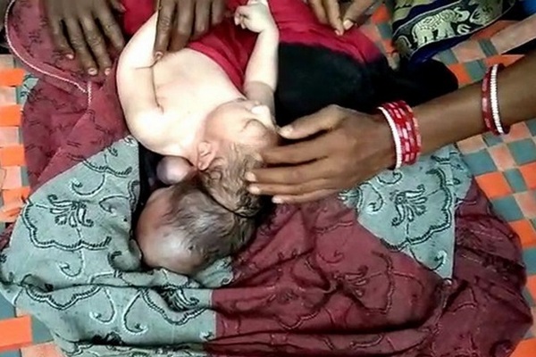 В Индии родился… трехглавый ребенок