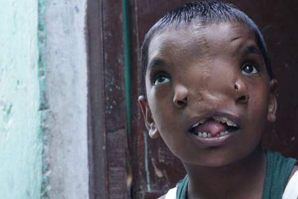 В Индии девочку с хоботом вместо носа признали воплощением божества