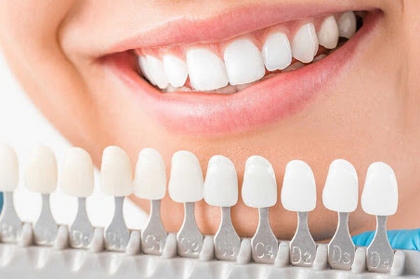 Вініри - одна з кращих розробок естетичної стоматології