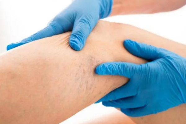 Симптомы, указывающие на проблемы с сосудами: как их распознать и поче