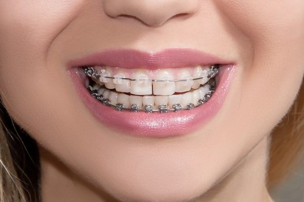 Причины кривизны зубов