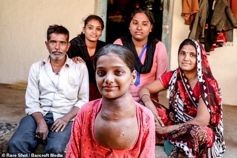 В Индии у 12-летней девочки выросла «вторая голова» на шее