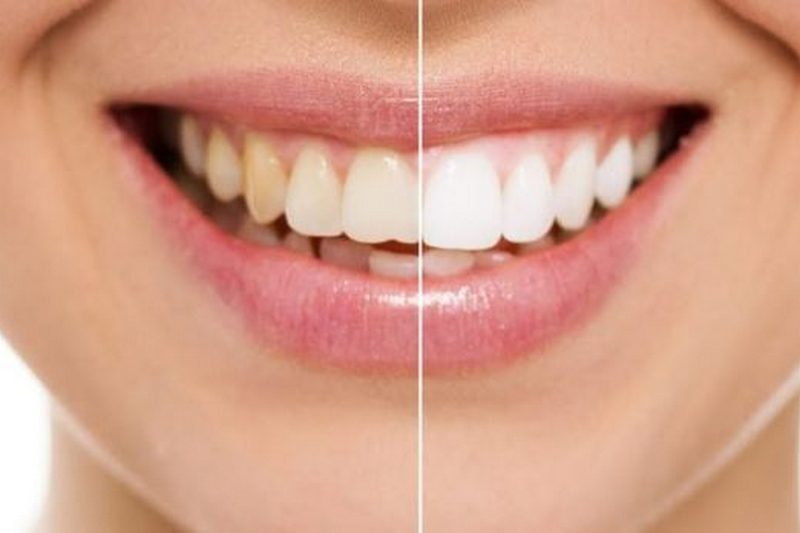 Стоматологи объяснили, как отбелить зубы в домашних условиях